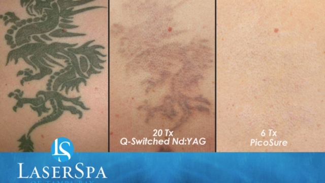 Laser Tattoo Removal Costs – Substantial Cost Of Tattoo Regret