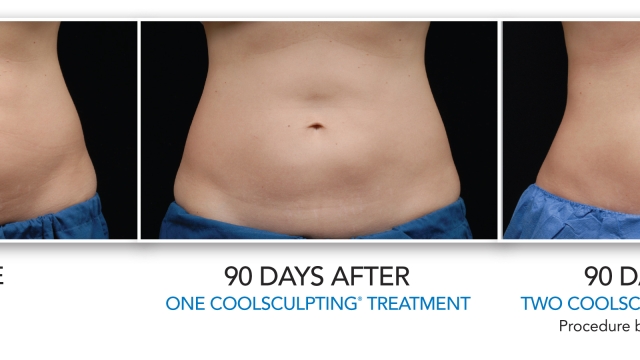 The Chilly Secret to a Sculpted Body: Exploring the Magic of Cool Sculpting