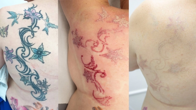 It Are Not The Fun – Tattoo Removal Pain Management