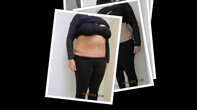 Reveal a Slimmer You: Unveiling the Power of Abdominoplasty