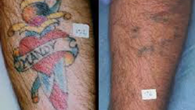 Tattoo Removal At Home – Things To Search For In At-Home Tattoo Removers