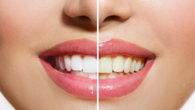 Shining Smiles: The Ultimate Guide to Teeth Whitening Products