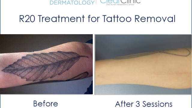 Tattoo Removal Costs – Finding An Inexpensive Way Eliminate Your Tattoo