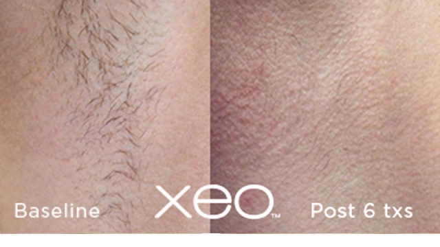 Laser Hair Removal: A Smooth Solution