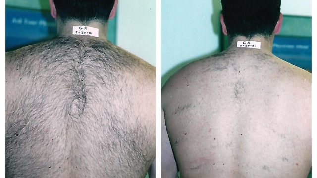 Gone in a Flash: Unveiling the Secrets of Laser Hair Removal